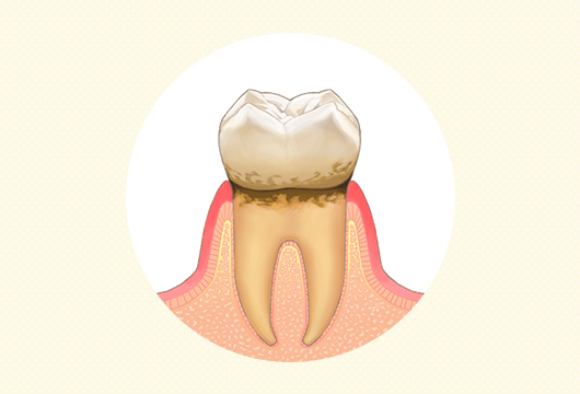 歯肉炎イラスト