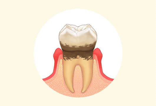 軽度歯周炎イラスト