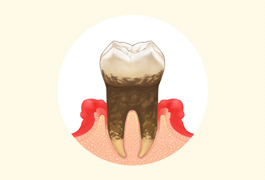 中等度歯周炎イラスト